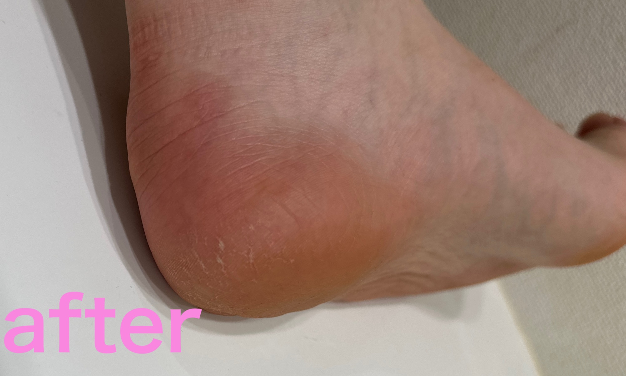 使用後のかかと