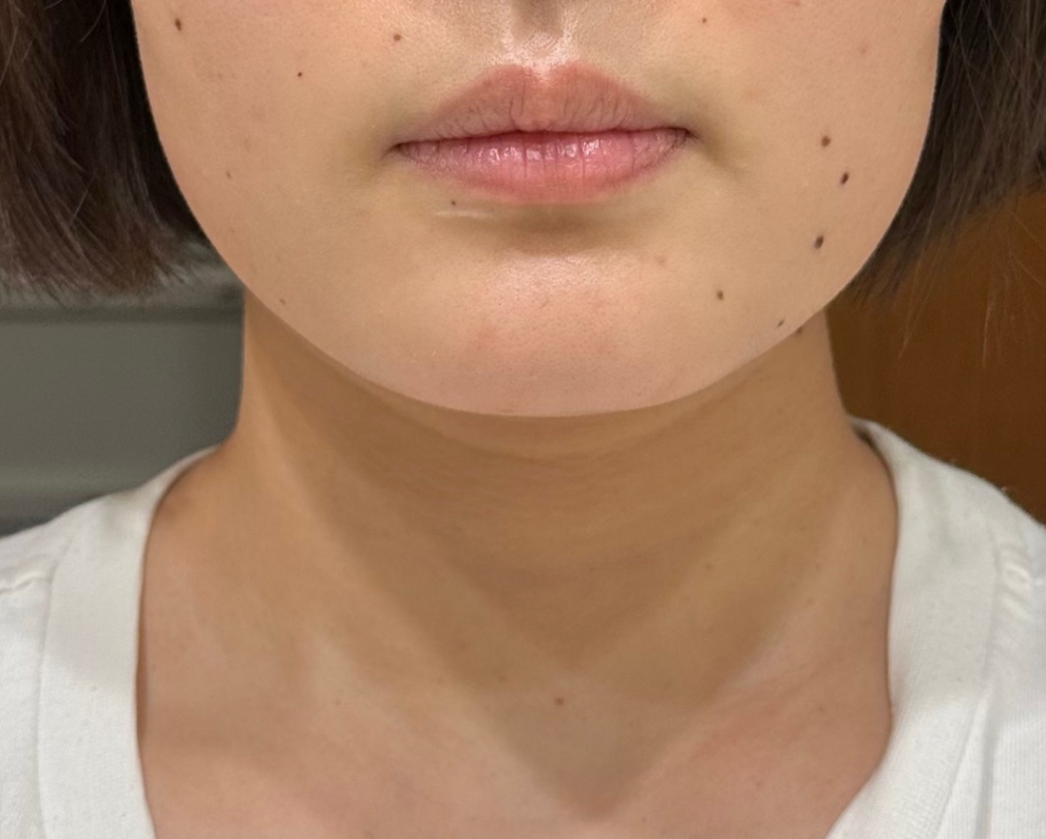 スノーセル美白サプリ 使用前の肌