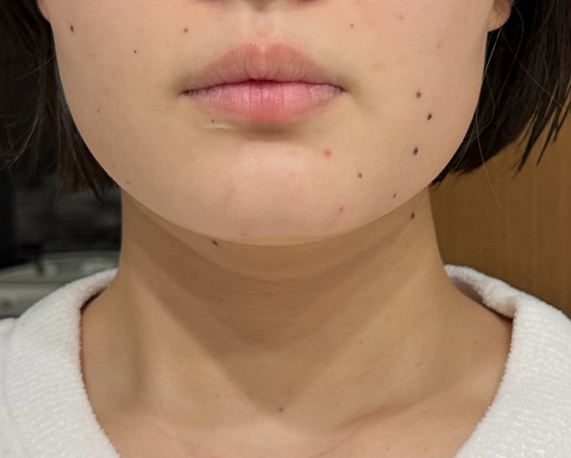 スノーセル美白サプリ　使用3日後の肌